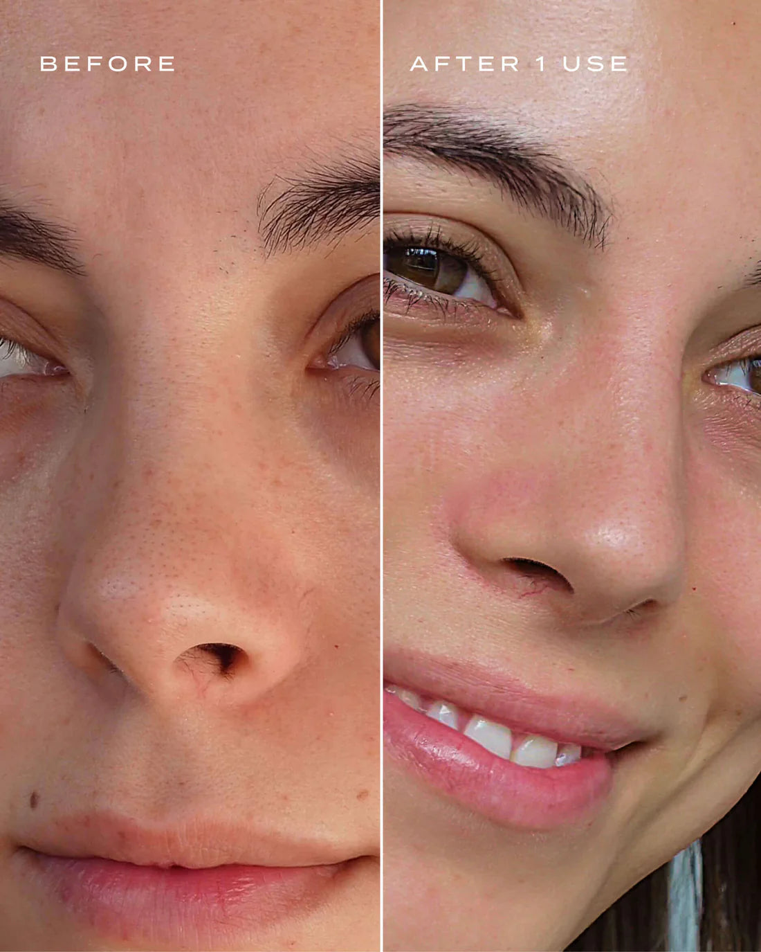 Vue - Nose Patches (50% OFF)